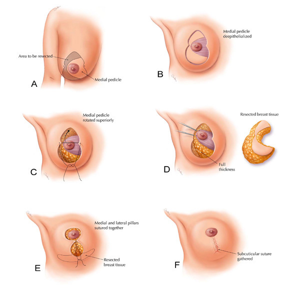breast reduction cyprus.jpg